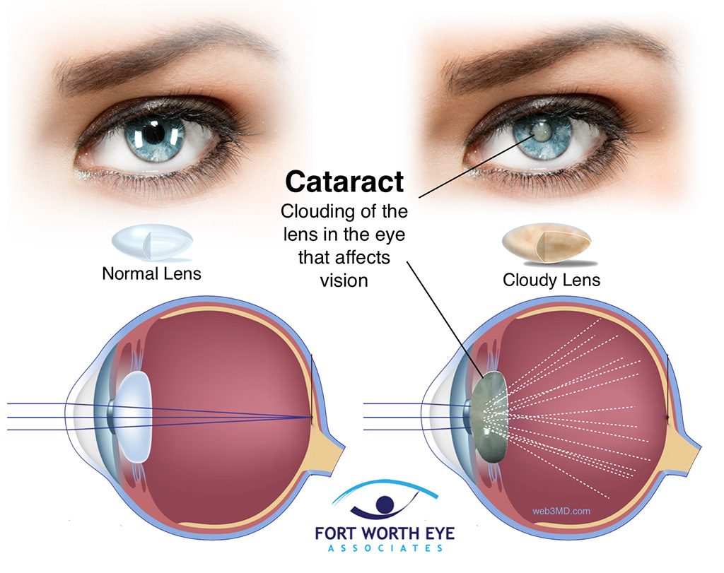 Post Cataract Surgery Update